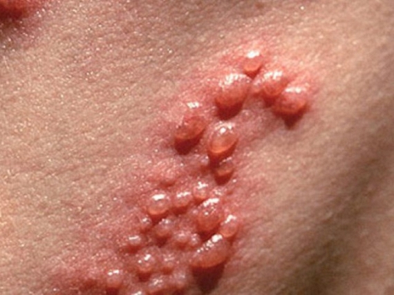 Viêm da mụn giộp  - Hình ảnh minh họa